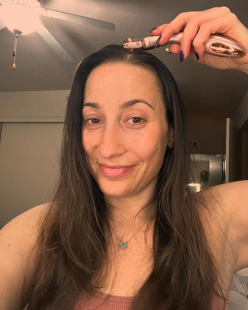 Scalp Microneedling